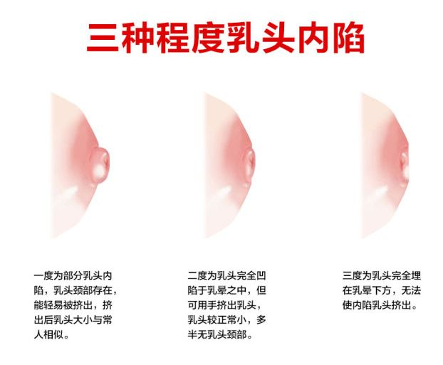 乳頭凹陷的媽媽該如何哺乳？